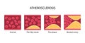 Cholesterol and atherosclerosis