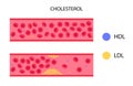 Cholesterol blood artery Royalty Free Stock Photo