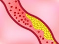 Cholesterol in blood vessel blocking flow of blood