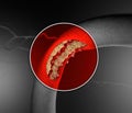 Cholesterol formation, fat, artery, vein, heart. Red blood cells, blood flow. Narrowing of a vein for fat formation