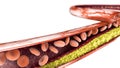 Cholesterol formation, fat. 3d section of an artery, vein and red blood cells, heart