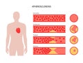 Cholesterol heart disease