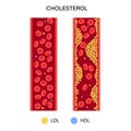 Cholesterol blood artery Royalty Free Stock Photo