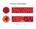 Cholesterol blood artery Royalty Free Stock Photo