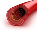 Cholesterol plaque in artery Royalty Free Stock Photo