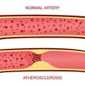 Cholesterol plaque in artery atherosclerosis illustration