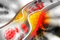 Cholesterol plaque in artery Royalty Free Stock Photo