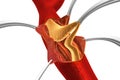 Cholesterol plaque in artery