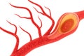 Cholesterol plaque in artery