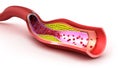 Cholesterol plaque in blood vessel