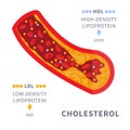 Cholesterol plaque buildup in blocked artery diagram Royalty Free Stock Photo