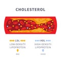 Cholesterol plaque buildup in blocked artery diagram Royalty Free Stock Photo