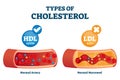 Cholesterol types comparison with HDL and LDL lipoprotein vector illustration Royalty Free Stock Photo