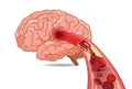 Cholesterol in veins made slow blood flow into brain.