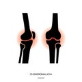 Chondromalacia and Knee Joint Icon Royalty Free Stock Photo