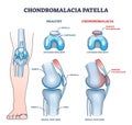 Chondromalacia patella knee breakdown compared with healthy outline diagram Royalty Free Stock Photo