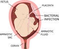 Chorioamnionitis or intra-amniotic infection IAI is an inflammation of the fetal membranes amnion and chorion due to a bacterial Royalty Free Stock Photo