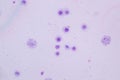 Chromosomes Human under the microscope for education.
