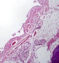 Chronic bronchitis, light micrograph