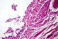 Chronic bronchitis, light micrograph