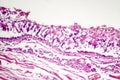 Chronic bronchitis under microscope Royalty Free Stock Photo