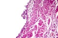 Chronic bronchitis under microscope