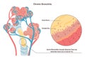 Chronic bronchitis. Pulmonary disease with airways mucus obstruction.