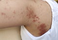 The chronic dermatitis, rash hives, allergy and peeling skin.