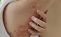 The chronic dermatitis, rash hives, allergy and peeling skin.