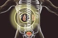 Chronic glomerulonephritis, gross pathology