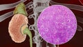 Chronic glomerulonephritis, gross pathology