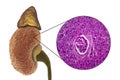 Chronic glomerulonephritis, gross pathology