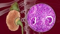 Chronic glomerulonephritis, gross pathology