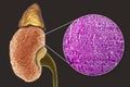 Chronic glomerulonephritis, gross pathology