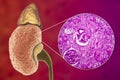 Chronic glomerulonephritis, gross pathology