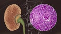 Chronic glomerulonephritis, gross pathology