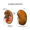 Glomerulonephritis. Royalty Free Stock Photo