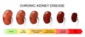 Chronic kidney disease. Stage of disorder