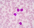 Chronic lymphocytic Leukemia(CLL)