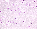 Blood smear. Chronic lymphocytic leukemia