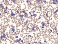 Chronic myelogenous leukemia.