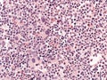 Chronic myeloid leukemia, bone marrow. Royalty Free Stock Photo