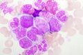 Chronic myeloid leukemia cells