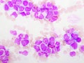 Chronic myeloid leukemia cells or CML Royalty Free Stock Photo