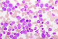 Chronic myeloid leukemia cells or CML Royalty Free Stock Photo