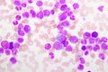 Chronic myeloid leukemia cells