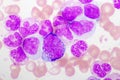 Chronic myeloid leukemia cells