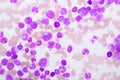 Chronic myeloid leukemia cells Royalty Free Stock Photo