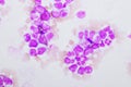 Chronic myeloid leukemia cells or CML Royalty Free Stock Photo