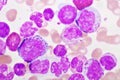 Chronic myeloid leukemia cells or CML Royalty Free Stock Photo